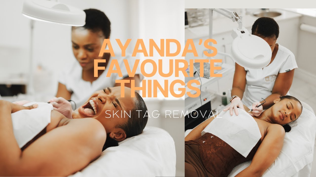 AYANDA’s FAVOURITE THINGS: I FINALLY DID IT!! SKIN TAG REMOVAL - PART 1