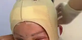 Botched Facelift get a Ghanaian lady looking like a beaten boxer – Video.