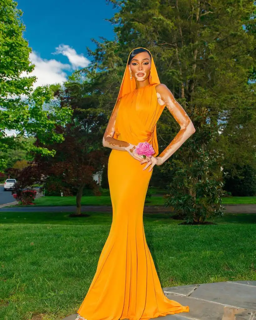 Winnie Harlow Biography, Age, Husband, Skin Disease, Sister, Baby Daddy, Height, Net Worth, and Career 1 Winnie Harlow Biography, Age, Husband, Skin Disease, Sister, Baby Daddy, Height, Net Worth, and Career