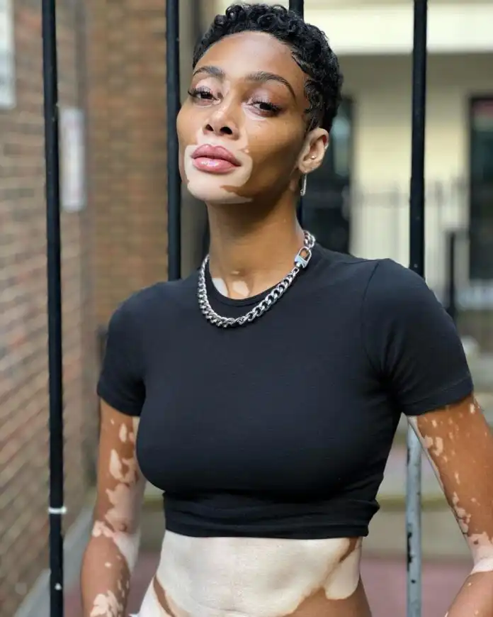 Winnie Harlow Biography, Age, Husband, Skin Disease, Sister, Baby Daddy, Height, Net Worth, and Career Winnie Harlow Biography, Age, Husband, Skin Disease, Sister, Baby Daddy, Height, Net Worth, and Career