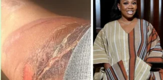 Wumi Toriola Opens Up About Her Scar Story