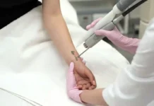 Beginner's Guide to Realistic Tattoo Removal Results